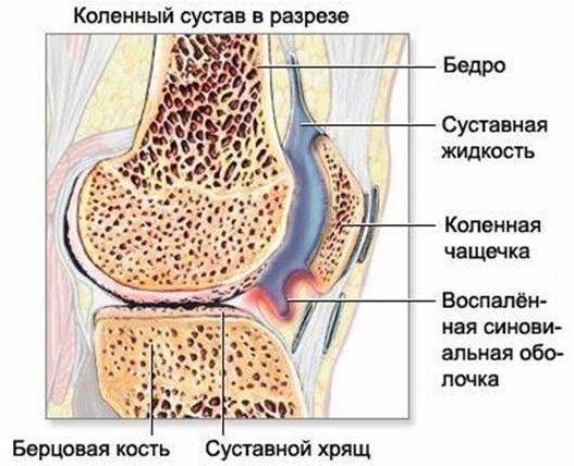 Остеопатия от ревматоидного артрита